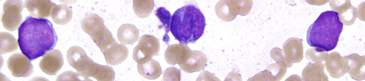 Fig 1F BMA 100x blasts and dysmonopoiesis